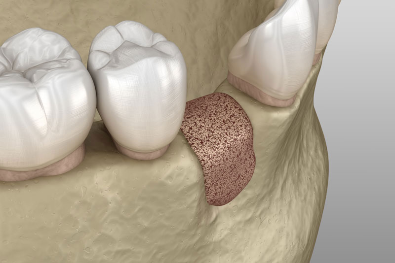 bone graft model