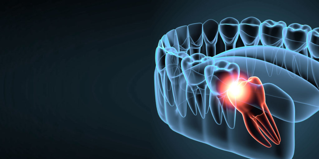 impacted tooth graphic