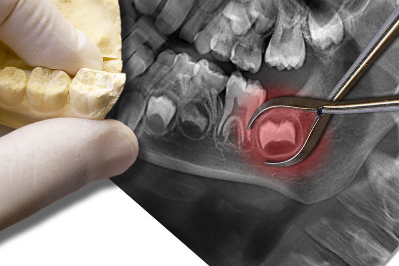 impacted wisdom tooth xray