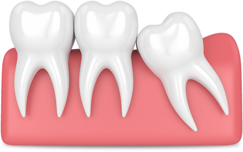 impacted wisdom tooth