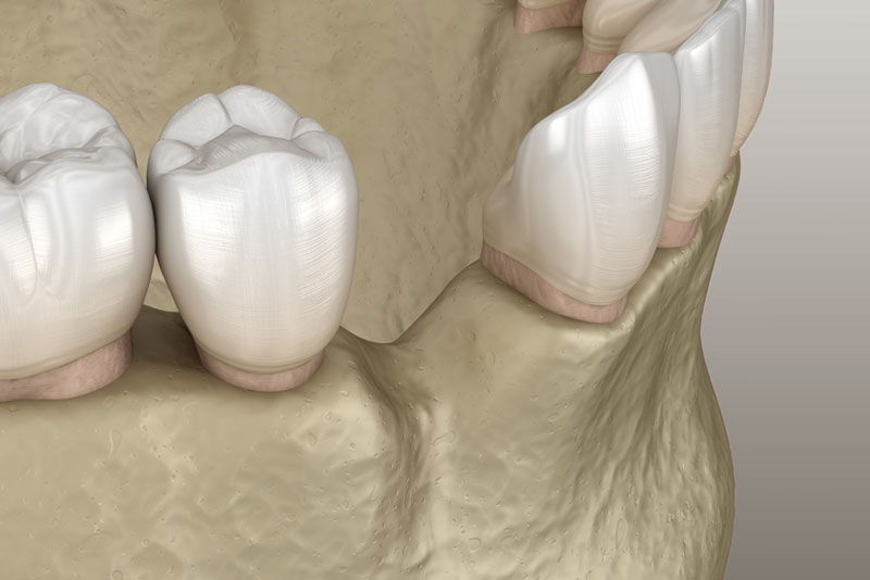 jaw bone recession