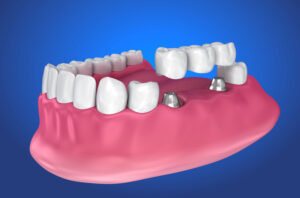 3d image of a dental implant bridge and a prosthesis jaw with a blue backdrop